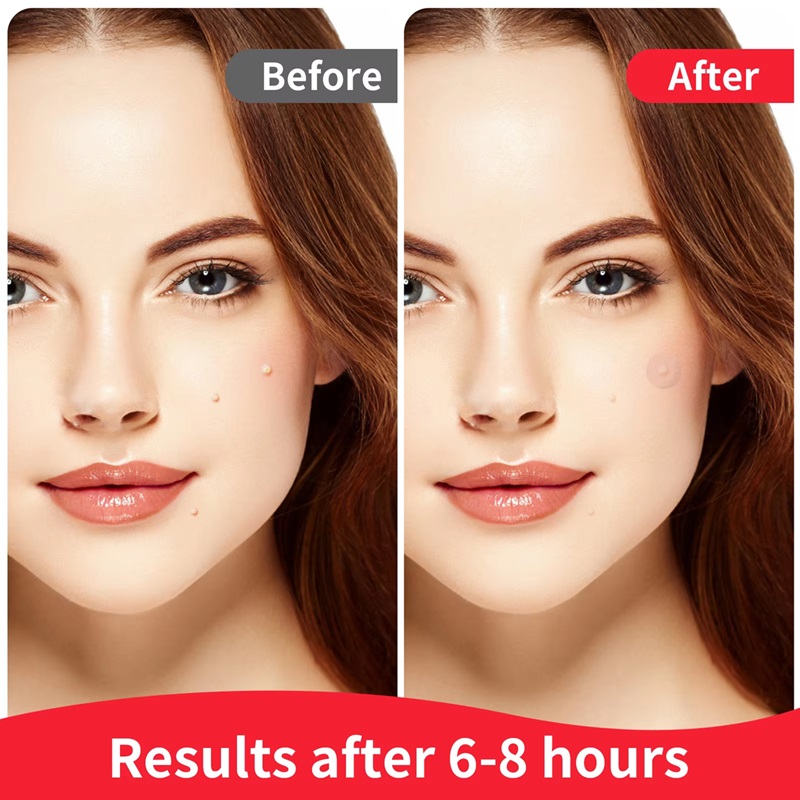 OEM Transparent Acne Cover Patch Acne Healing Patch for All Types Acne Spot