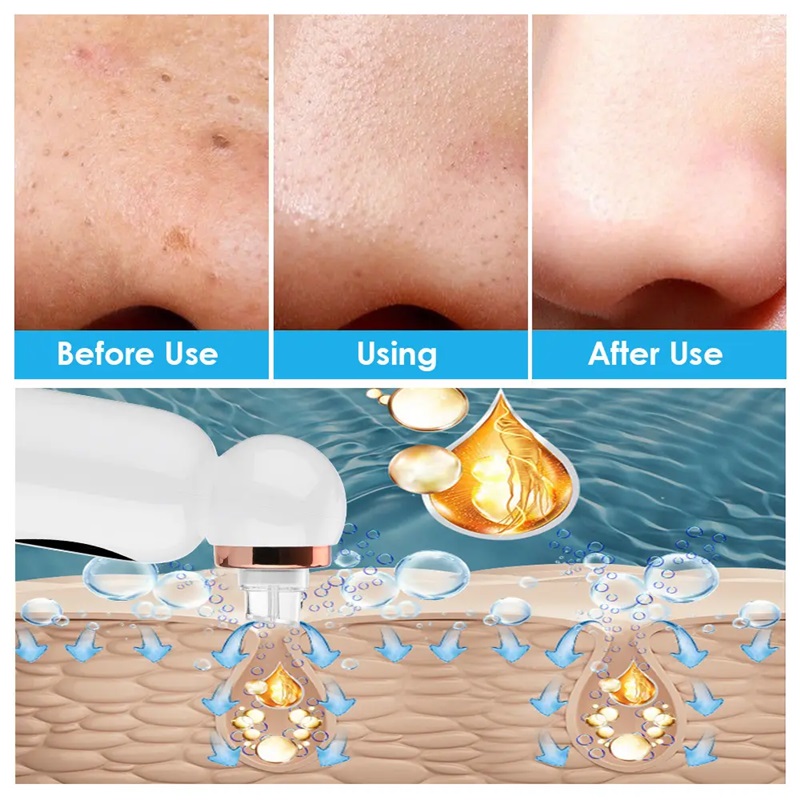 Pore Vacuum Blackhead Remover